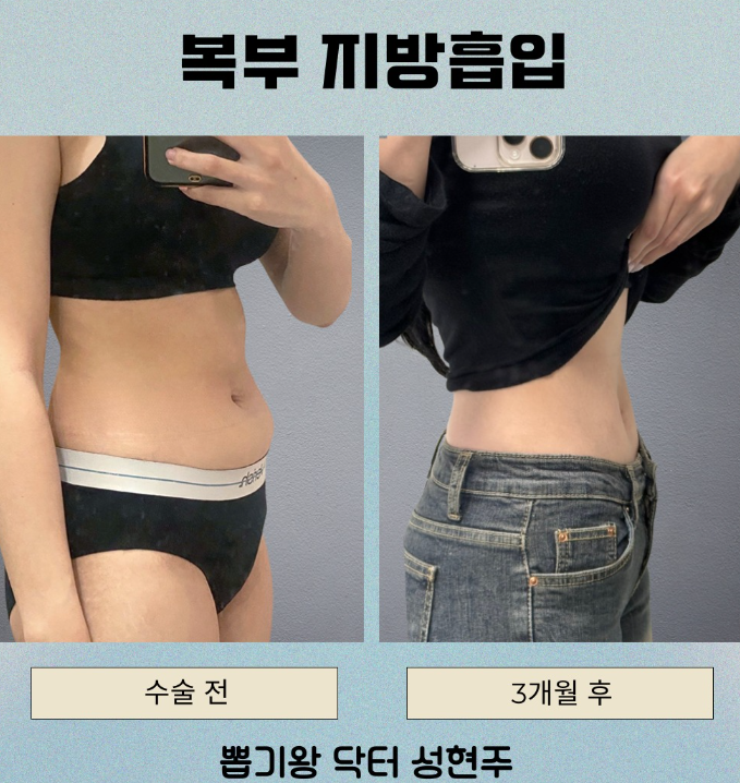 뱃살빼는법, 다이어트해도 남는 복부지방 해결할 수 있을까? 관련 이미지 7