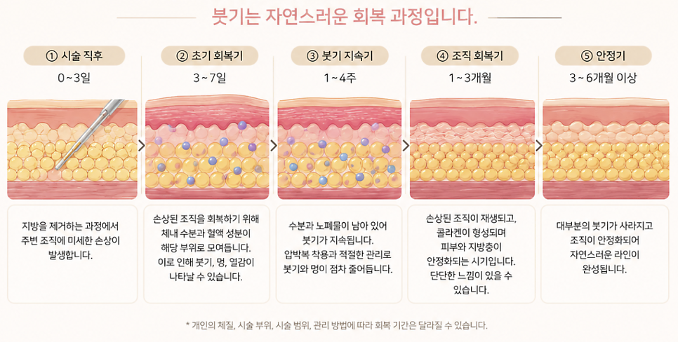 지방흡입붓기 언제 빠질까? 1주&middot;1개월&middot;3개월 회복 과정 정리 관련 이미지 4
