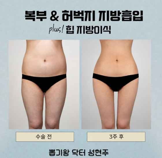 압구정성형외과, 지방흡입과 지방이식 차이 알려드립니다 관련 이미지 7