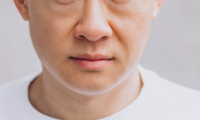 Seoul Fat Grafting Good Place: Facial Fat Grafting vs. Filler, the Difference in Results Is Bigger Than You Think image 8