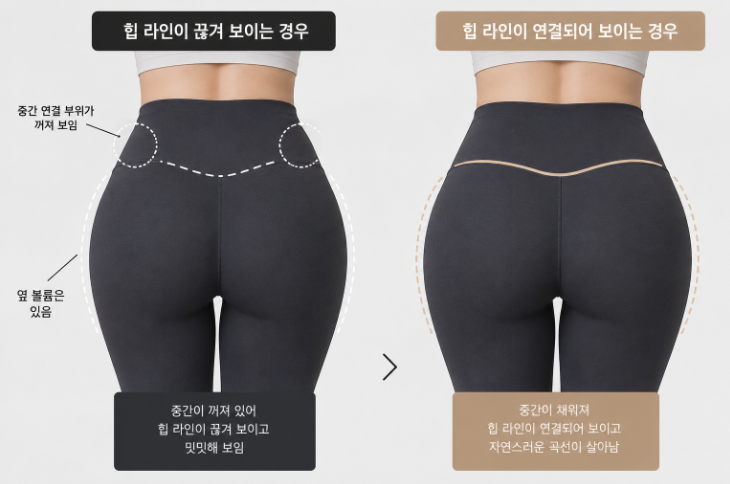 Hip Dip Fat Grafting: In What Cases Is Fat Grafting More Suitable Than Fillers? image 4