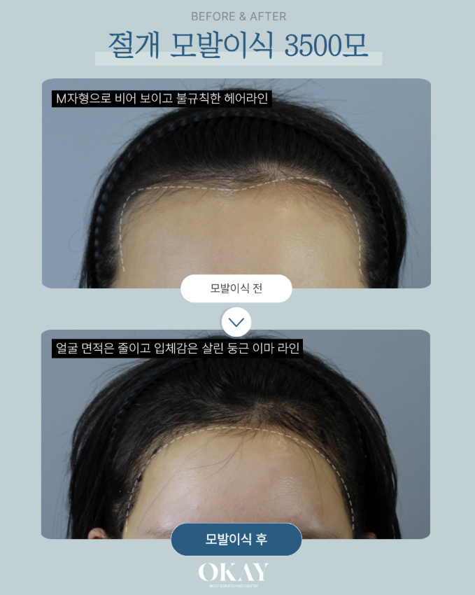 서울 앞머리 모발이식, 절개 vs 비절개 어떤 선택이 맞을까 관련 이미지 7
