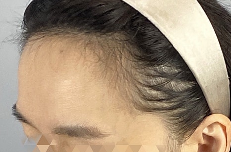 압구정 여자 M자 모발이식 비절개? 몇모가 적당할까, 디자인&middot;자연스러움&middot;회복기간 정리 관련 이미지 11