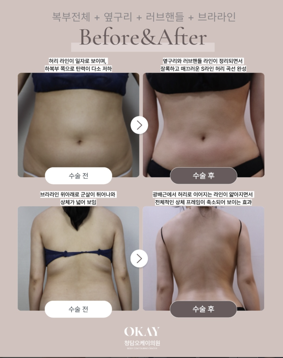 Side Waist Liposuction: Who Develops Side Effects (Bruising·Swelling·Unevenness) and Who Doesn't image 10