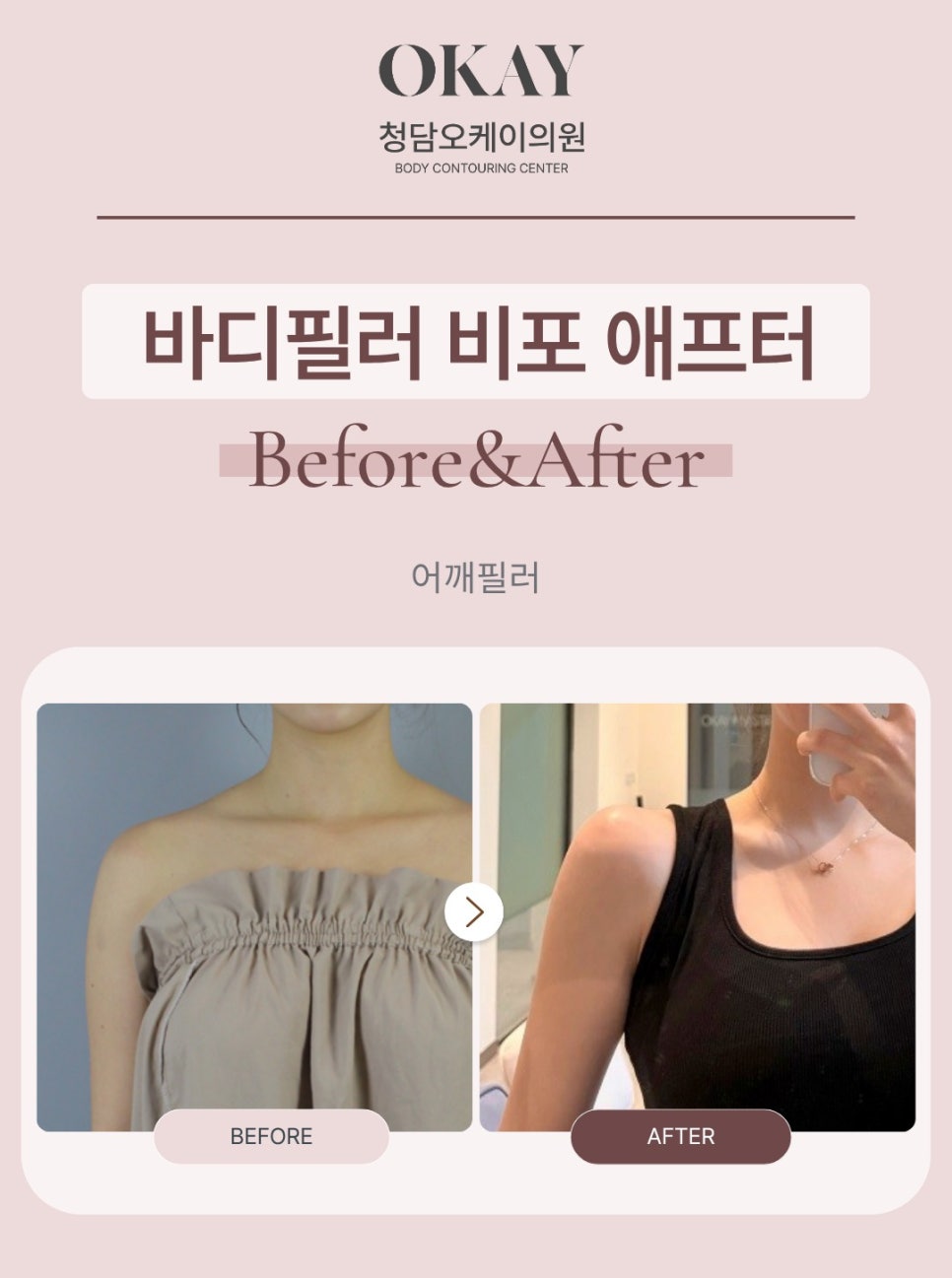 어깨필러 후기, 예쁜 직각어깨는 이렇게 만들어집니다 관련 이미지 5