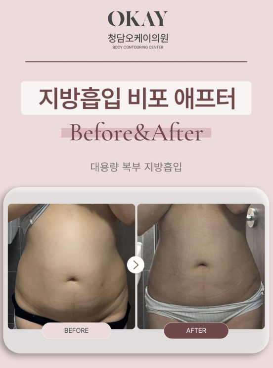 아랫배빼는법, 복부지방은 무조건 많이 빼면 될까? 관련 이미지 3