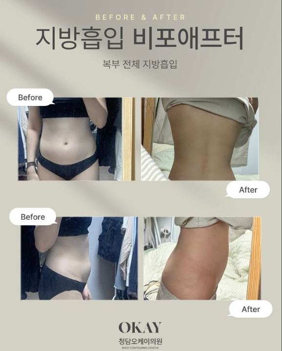 복부지방흡입부작용, 흉터보다 더 신경써야 할 문제 울퉁불퉁함&middot;처짐&middot;유착이 생기는 이유 관련 이미지 6