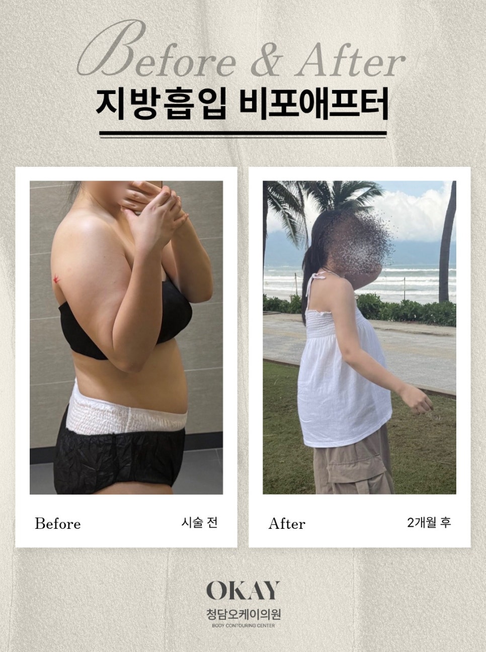 팔뚝지방흡입, 승모근&middot;부유방까지 함께 봐야 하는 이유 관련 이미지 2
