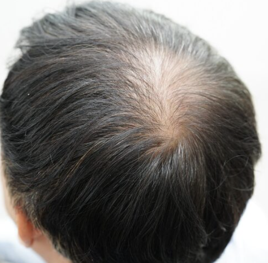 서울모발이식병원, 모발이식 실패를 줄이려면 확인할 것은? 관련 이미지 4
