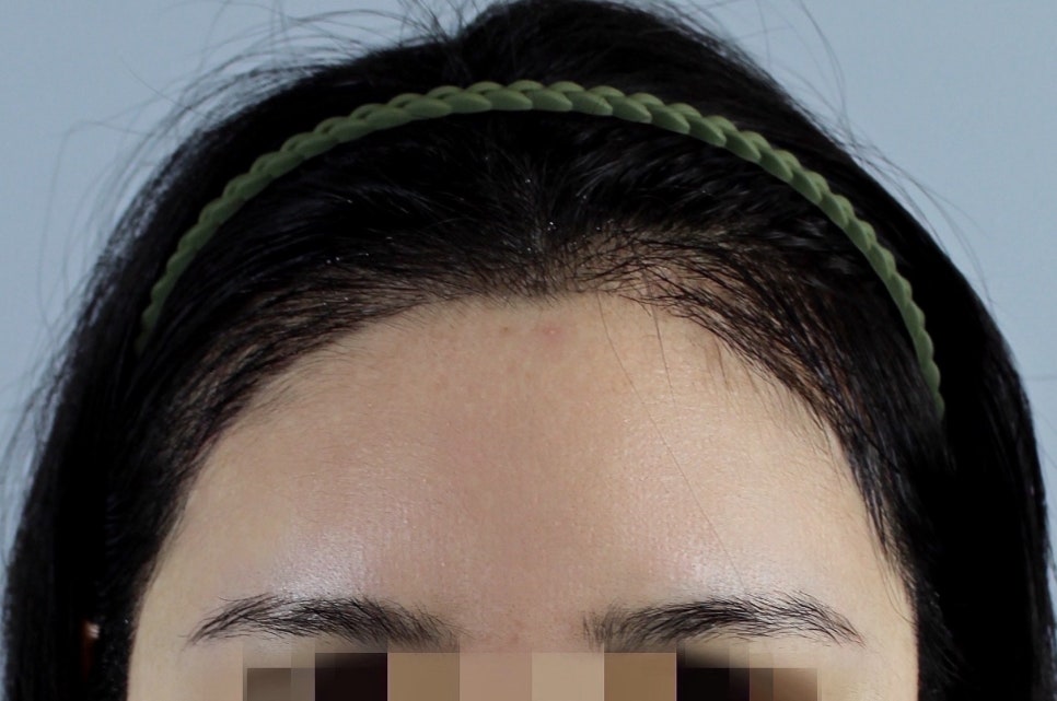 Can Hair Transplant Graft Survival Rates Differ Between Non-Excision and Excision Methods? Comparing Differences in Recovery Management image 7