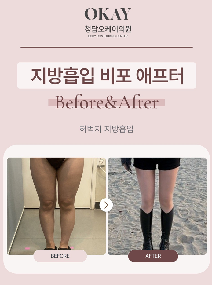 압구정로데오 성형외과, 지방흡입은 양보다 디자인입니다 관련 이미지 10