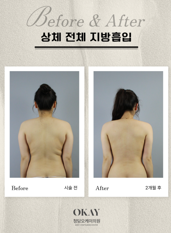 지방흡입수술비용, 가격보다 먼저 확인해야 할 것은? 관련 이미지 5
