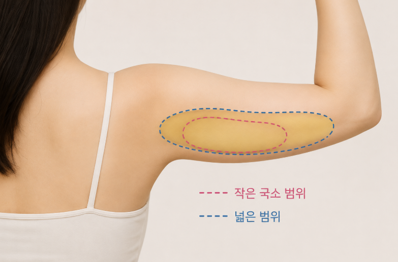 팔뚝 지방추출주사, 지방흡입과 뭐가 다를까요? 효과·비용까지 비교 관련 이미지 8