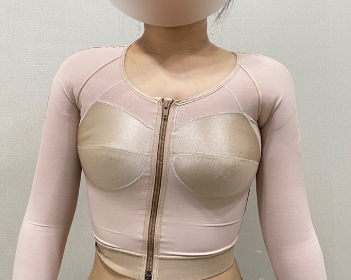 From 2 Weeks to 3 Months After Arm Liposuction: How Does the Arm Contour Change? image 10