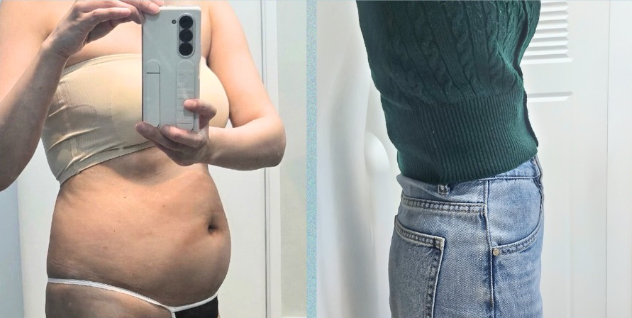 If you’re 고민ing about belly fat liposuction, which method is right for you in terms of price, side effects, and recovery period? image 4