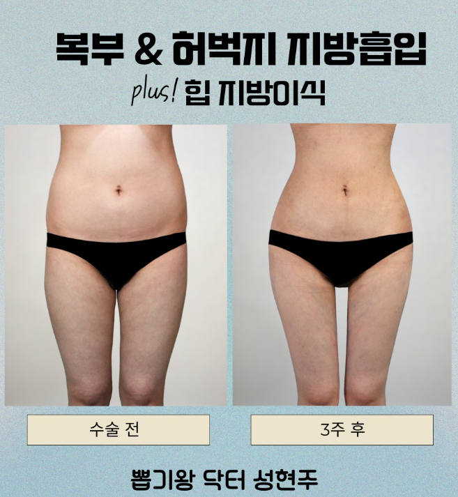 지방흡입잘하는병원 찾는다면? 부위보다 중요한 건 전체 라인 관련 이미지 8