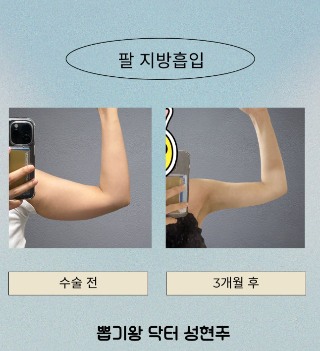 부유방빼기, 팔을 내렸을 때 더 튀어나와 보이는 이유는? 관련 이미지 9