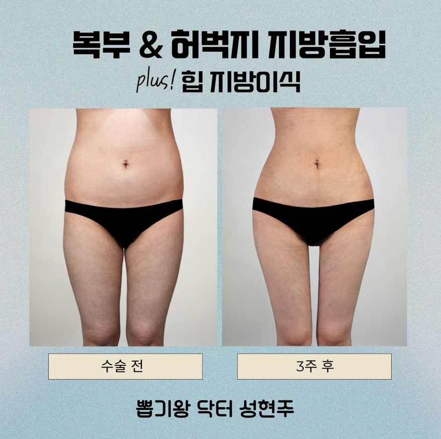 골반지방이식 후 부작용, 자연스러운 라인을 위해 확인해야 할 기준 관련 이미지 7