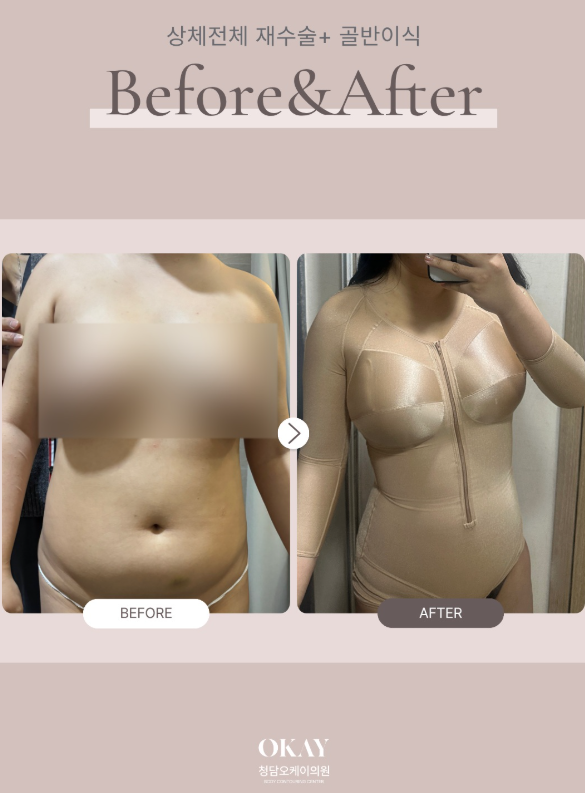 지방흡입통증, 수술 후 며칠까지 아플까요? 관련 이미지 7