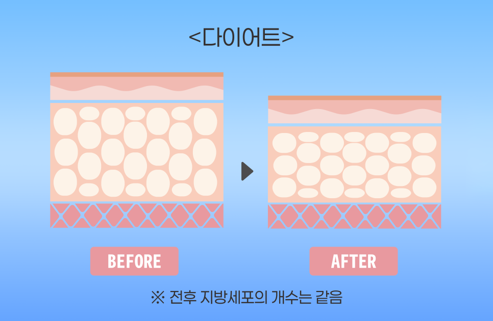 [청담오케이의원] 지방흡입 먼저? 다이어트 먼저? 관련 이미지 3