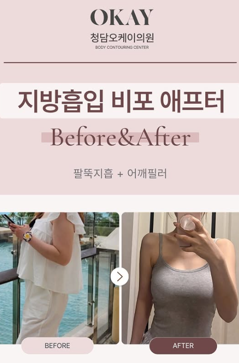 어깨필러, 직각어깨를 원한다면 라인부터 확인해야 하는 이유 관련 이미지 8