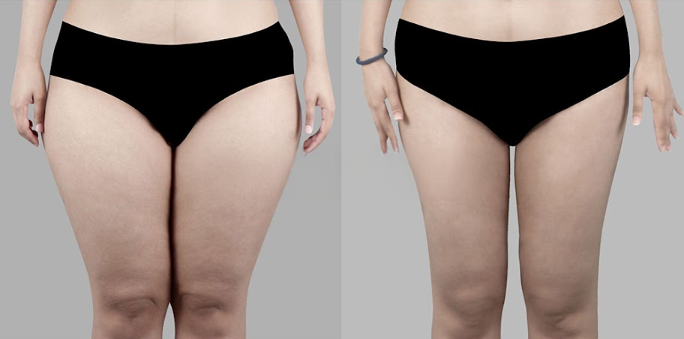 Subgluteal Liposuction: Why Results Differ Depending on Skin Elasticity and Sagging image 7