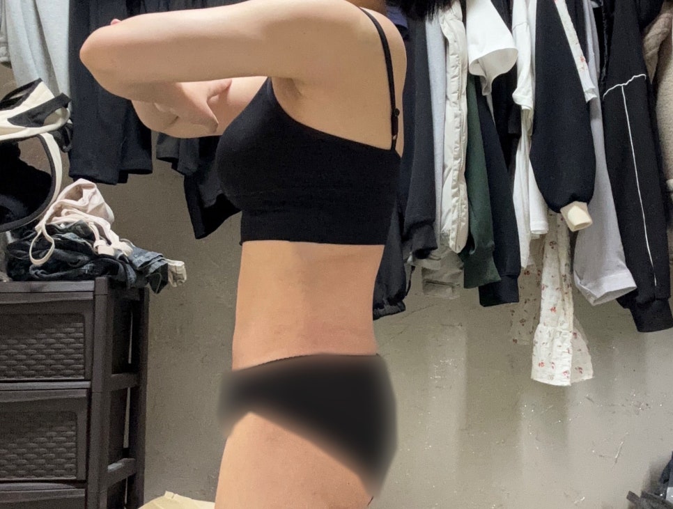 Apgujeong Liposuction Scars: Cases That Stand Out Are Distinctly Different — A Summary by Location and Recovery Period image 7