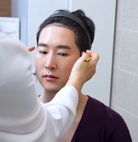 남자헤어라인모발이식, 부자연스러워 보이는 이유를 설명드립니다 관련 이미지 3