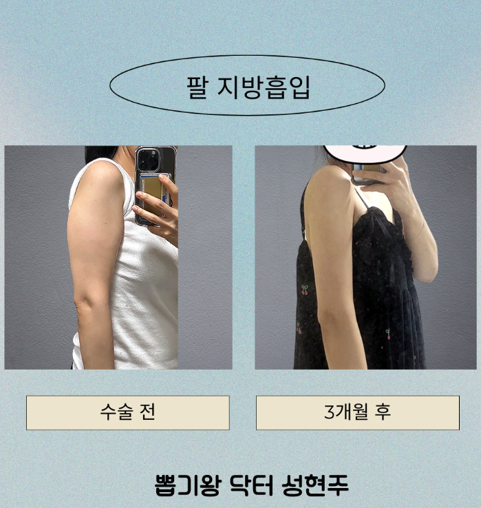 팔뚝지방흡입수술비용, 겨드랑이·부유방까지 하면 얼마나 달라질까? 관련 이미지 4