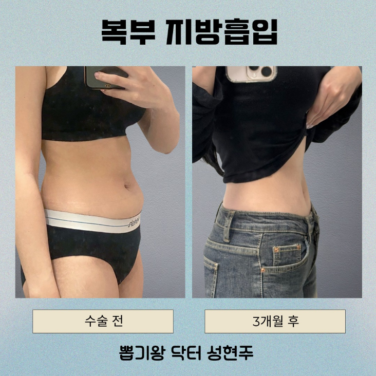 복부지흡 회복기간 얼마나 걸릴까? 붓기&middot;압박복&middot;일상 복귀 기준 관련 이미지 11