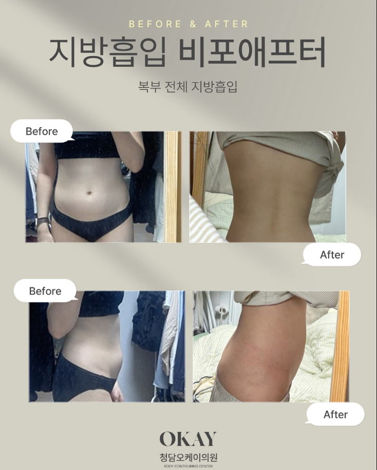 지방흡입가격 저렴한 곳만 찾다가 재수술 고민하는 경우도 있습니다 관련 이미지 7