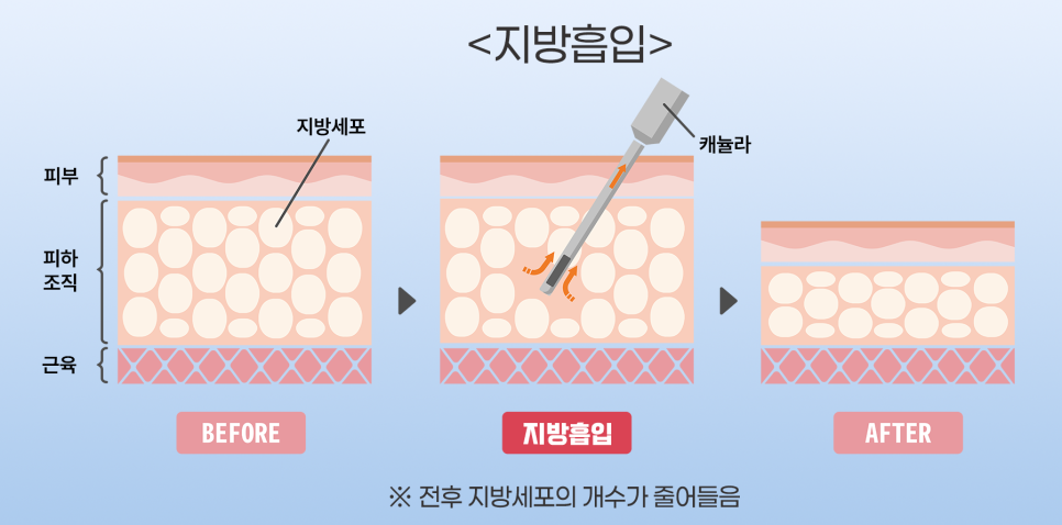 [청담오케이의원] 지방흡입 먼저? 다이어트 먼저? 관련 이미지 4