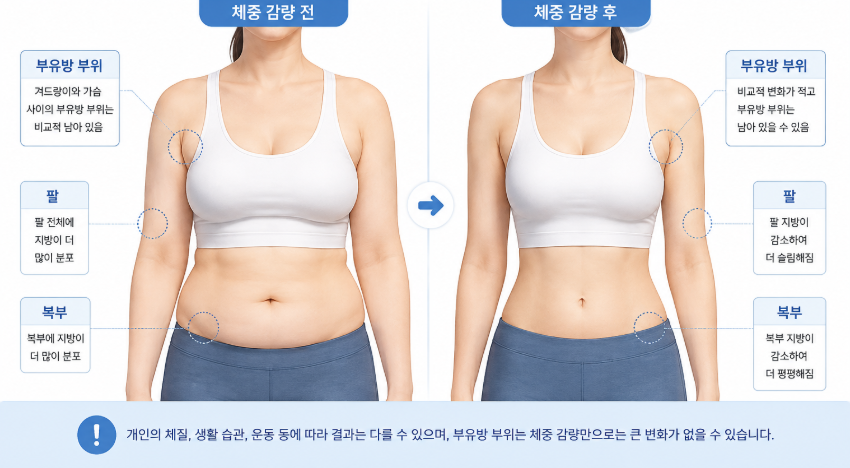 부유방제거수술, 살을 빼도 겨드랑이가 그대로라면? 관련 이미지 4