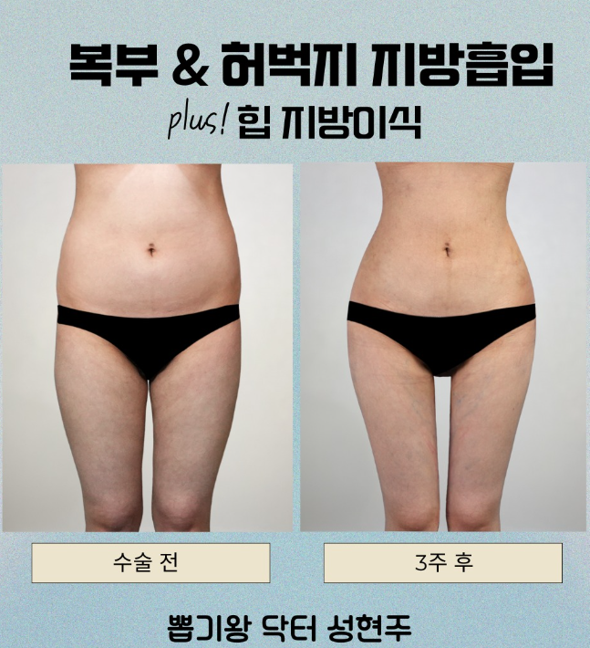 강남전신지방흡입, 팔·복부·허벅지 한 번에 고민한다면 관련 이미지 8