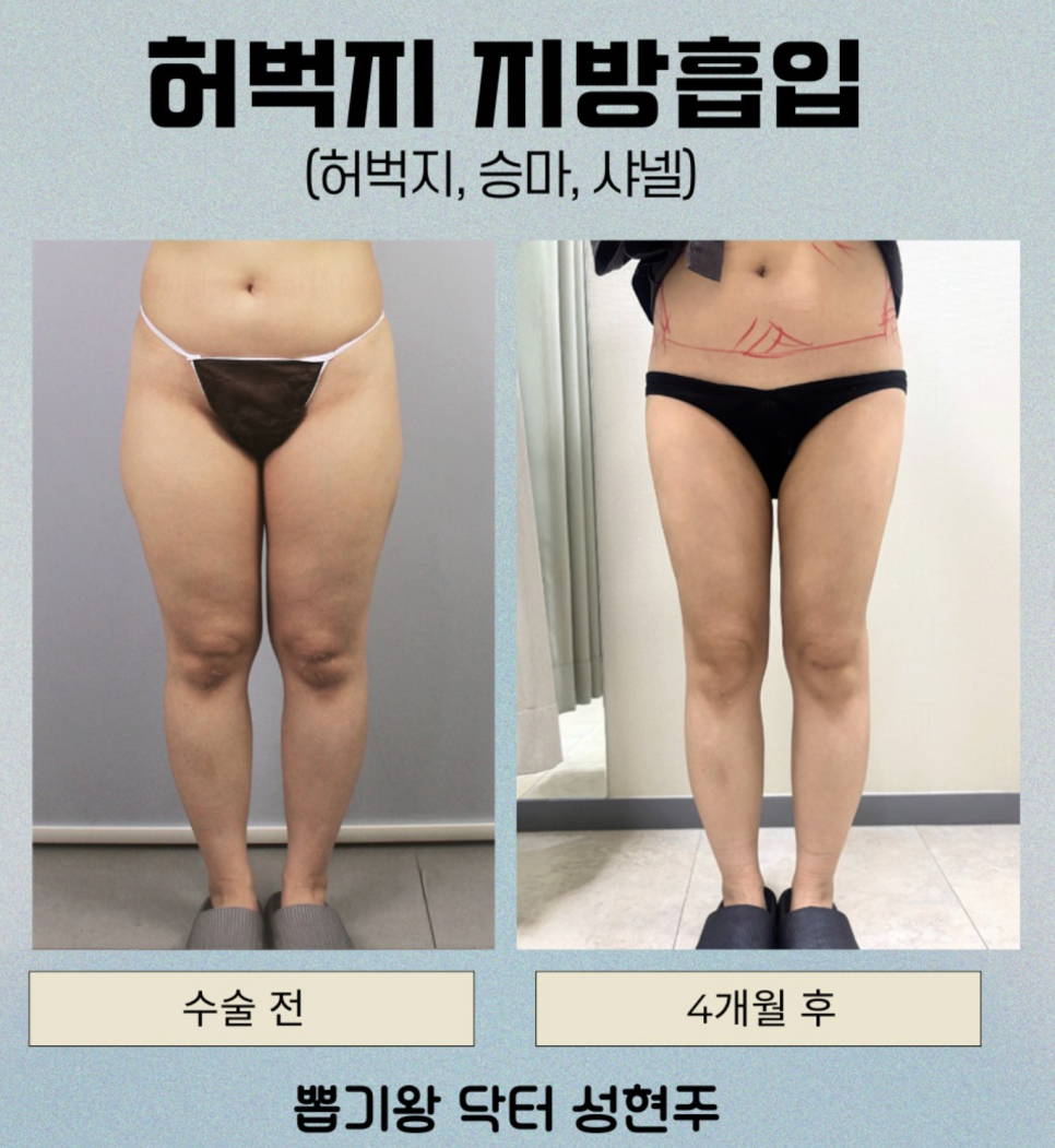 허벅지지방흡입후관리, 붓기와 통증을 줄이기 위해 중요한 것은? 관련 이미지 2