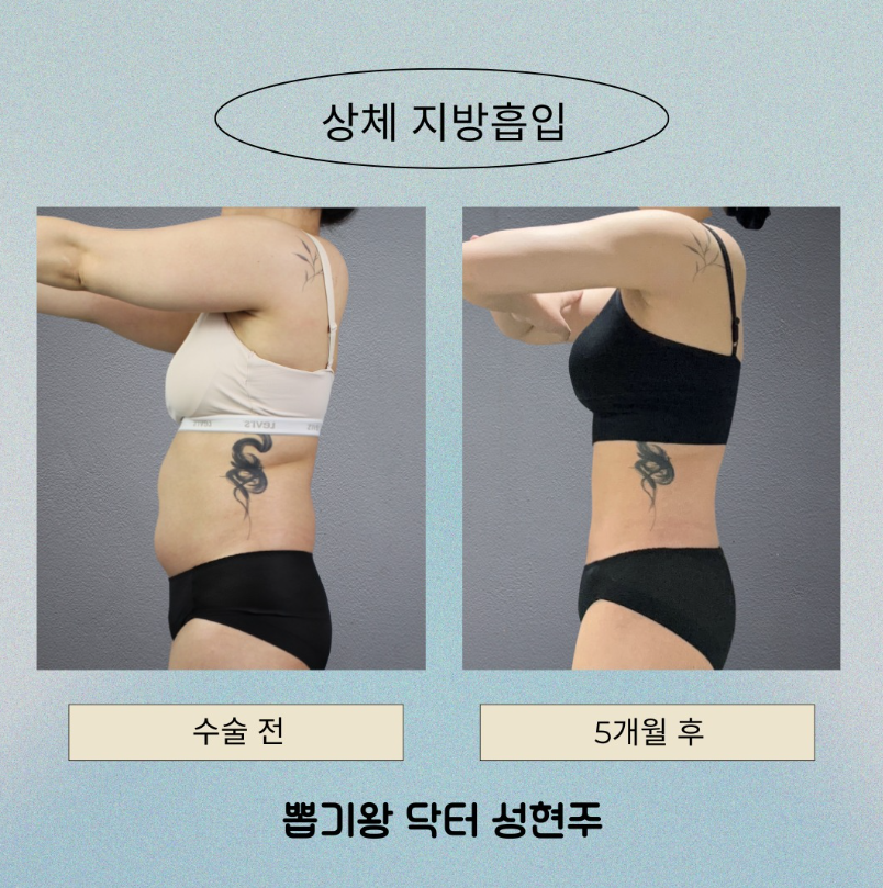 러브핸들지방흡입, 옆구리살만 빼도 허리라인이 달라질까요? 관련 이미지 8