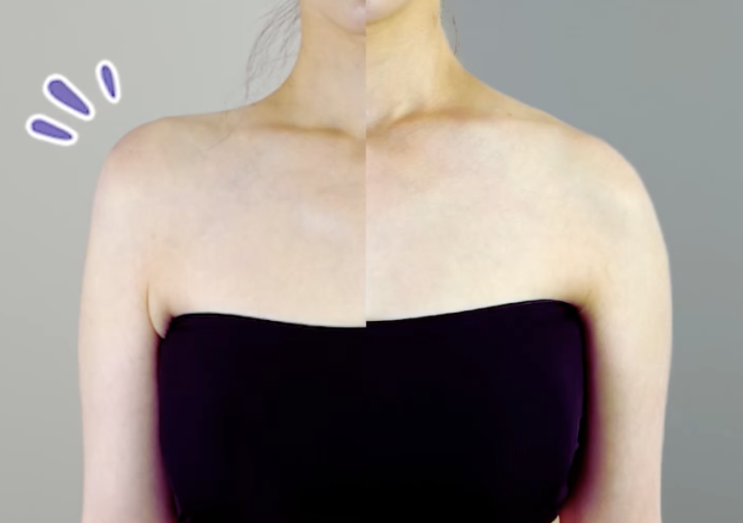 What to Do If You Experience Shoulder Filler Side Effects: Stay Calm and Check These Points image 10