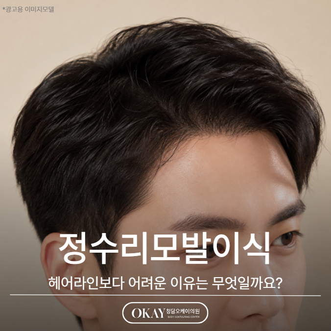 정수리모발이식, 헤어라인보다 어려운 이유는 무엇일까요? 관련 이미지 1