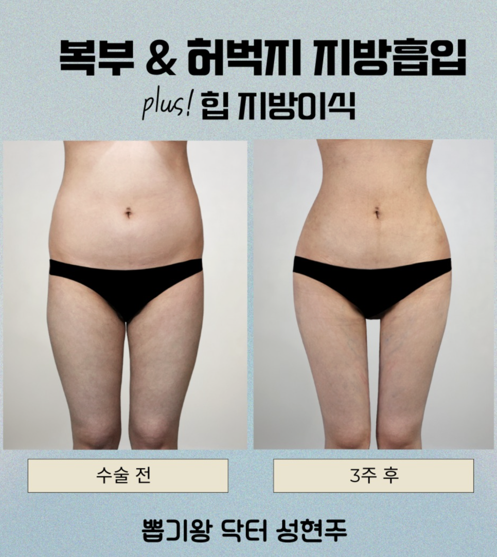 Liposuction Stitches: Removing Them Doesn’t Mean It’s Over! Why Aftercare Matters image 7