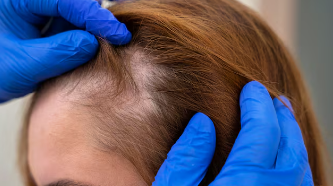 Gangnam Hair Loss Clinic: There Are Specific Cases When Hair Transplantation Is Necessary image 4