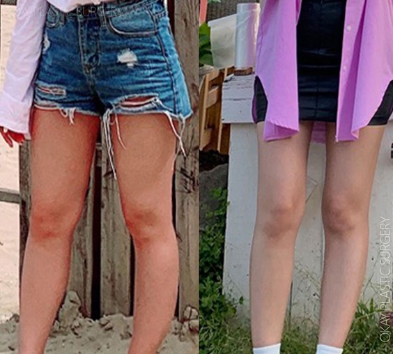 하체비만 허벅지지방흡입 효과 보려면 안쪽 지방부터 확인해야 하는 이유 관련 이미지 5
