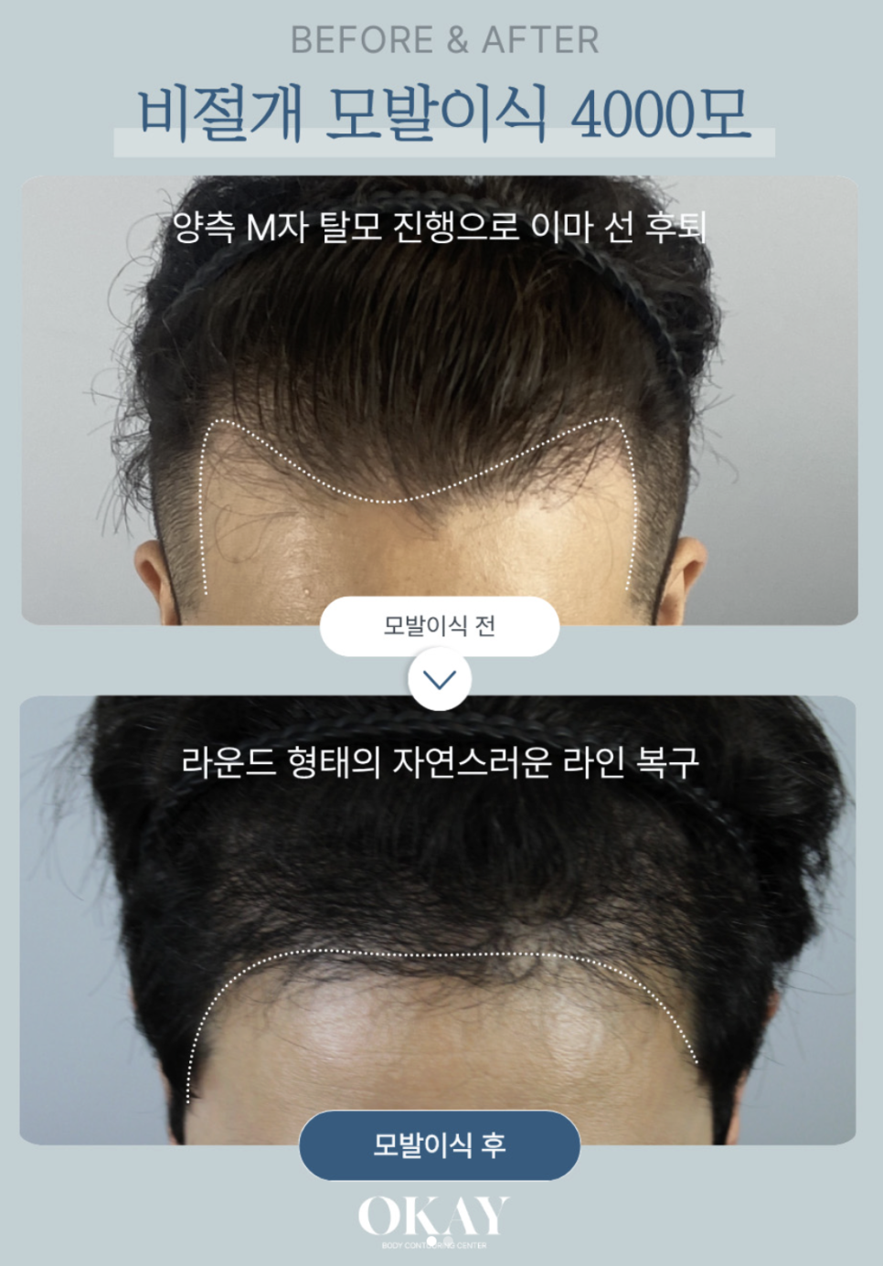 모발이식생착기간, 언제부터 안심해도 될까요? 딱지·운동·모자까지 총정리 관련 이미지 11