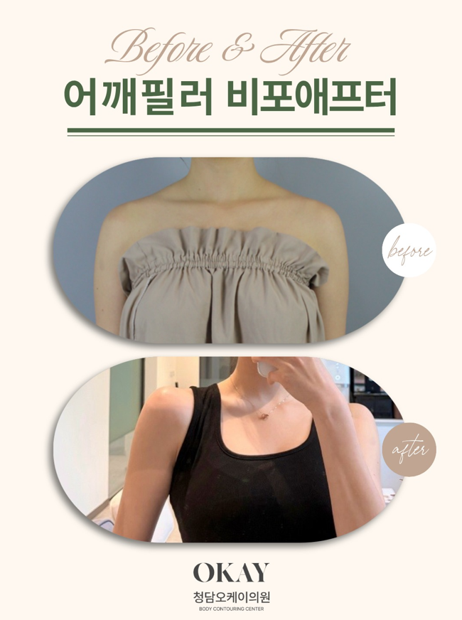 청담역성형외과 어깨필러, 어깨라인이 예뻐 보이는 사람들의 공통점 관련 이미지 8