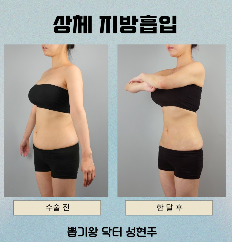 뱃살지흡 후기, 아랫배부터 옆구리까지 어디까지 달라질까요? 관련 이미지 6