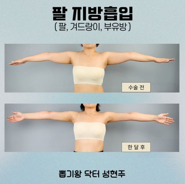 What Are the Liposuction Surgery Methods in Gangnam? A Summary of Procedure Types and Differences image 6