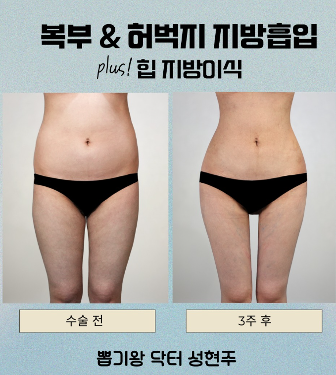 엉덩이지방이식, 힙라인이 달라 보이는 핵심은 따로 있습니다 관련 이미지 5