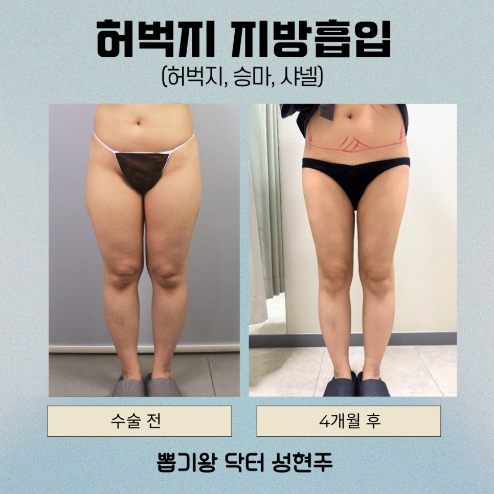 Why Satisfaction Differs After Thigh Liposuction: What You Miss When You Focus Only on the Inner Thighs image 9