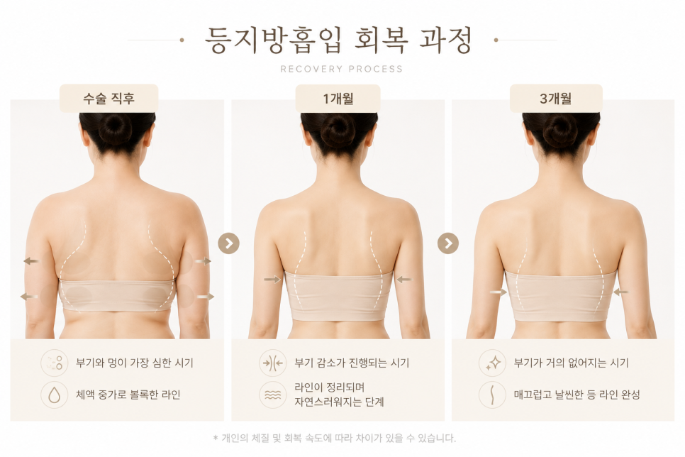 등지방흡입압박복, 꼭 입어야 할까? 회복 결과를 좌우하는 이유 관련 이미지 7