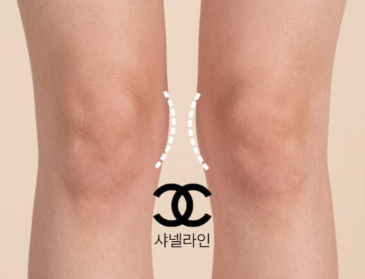 하체비만 허벅지지방흡입 엉덩이&middot;샤넬라인 함께 잡히는지 현실적으로 따져봤습니다 관련 이미지 3