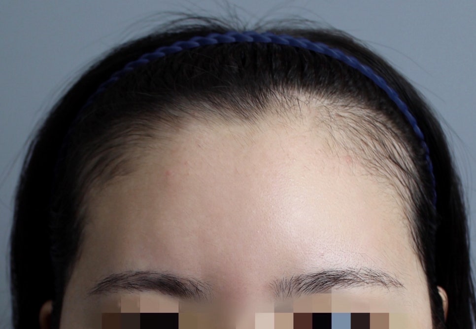 Can Hair Transplant Graft Survival Rates Differ Between Non-Excision and Excision Methods? Comparing Differences in Recovery Management image 6